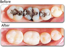 White cosmetic fillings